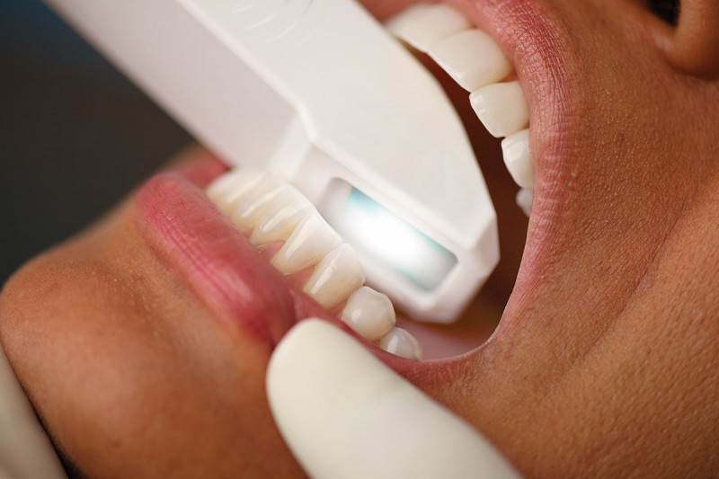Intraoraler Scan mit Itero-Scannre