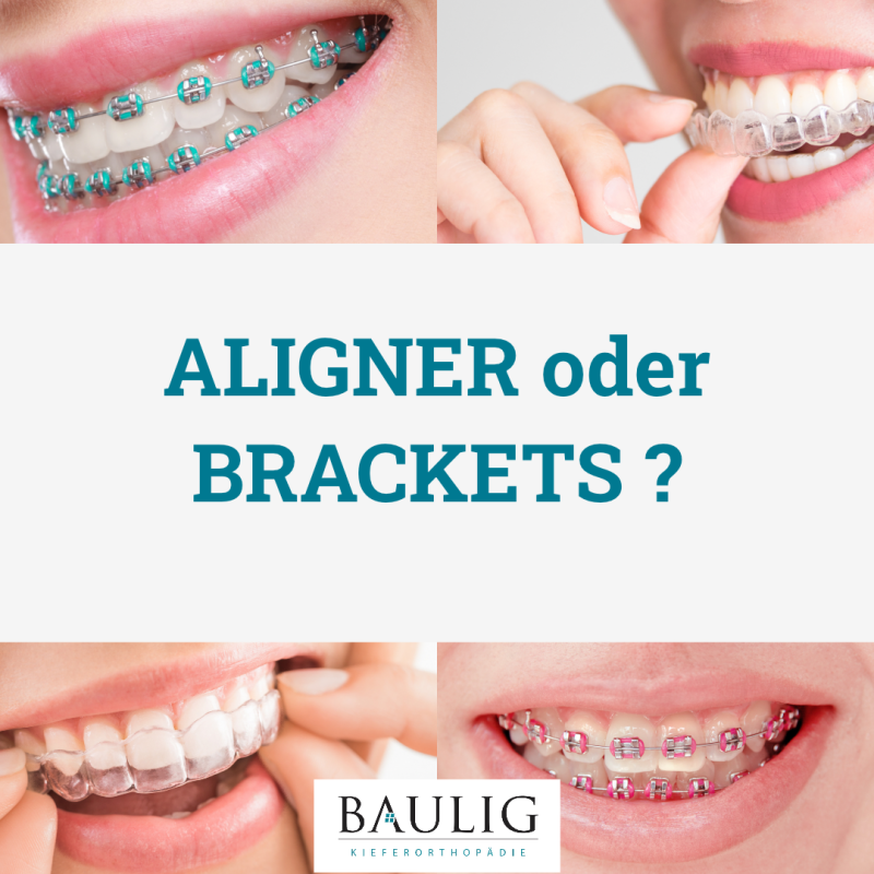 Multiband oder Alignertherapie?