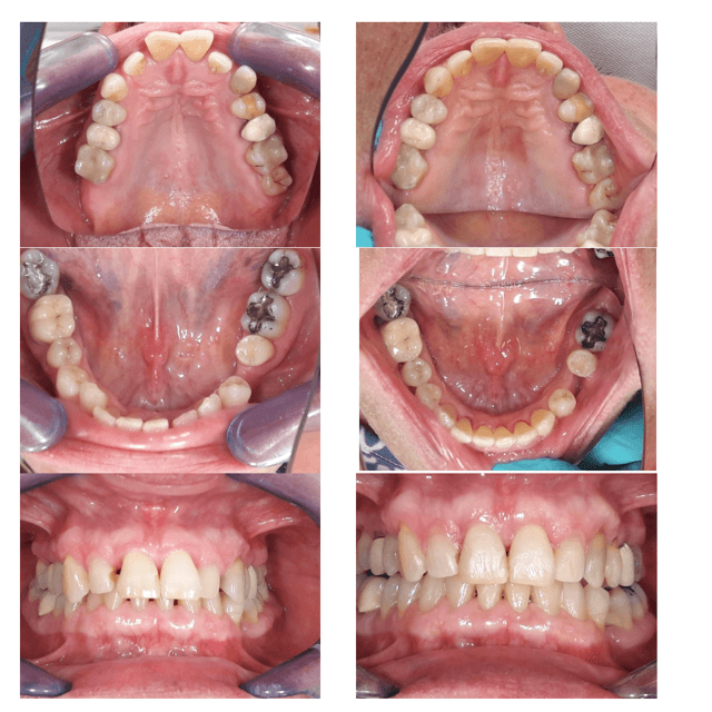 Therapie im parodontal vorgeschädigten Gebiss mit Invisalign